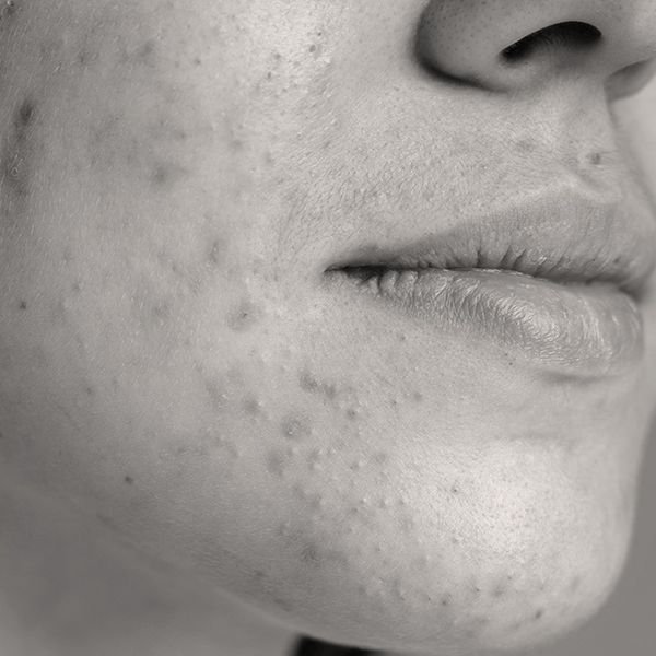 Anti Acne